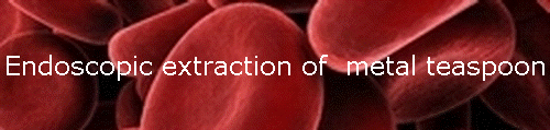 Endoscopic extraction of  metal teaspoon